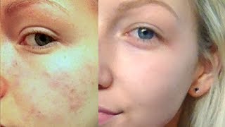 How I cleared my skin |! skincare update